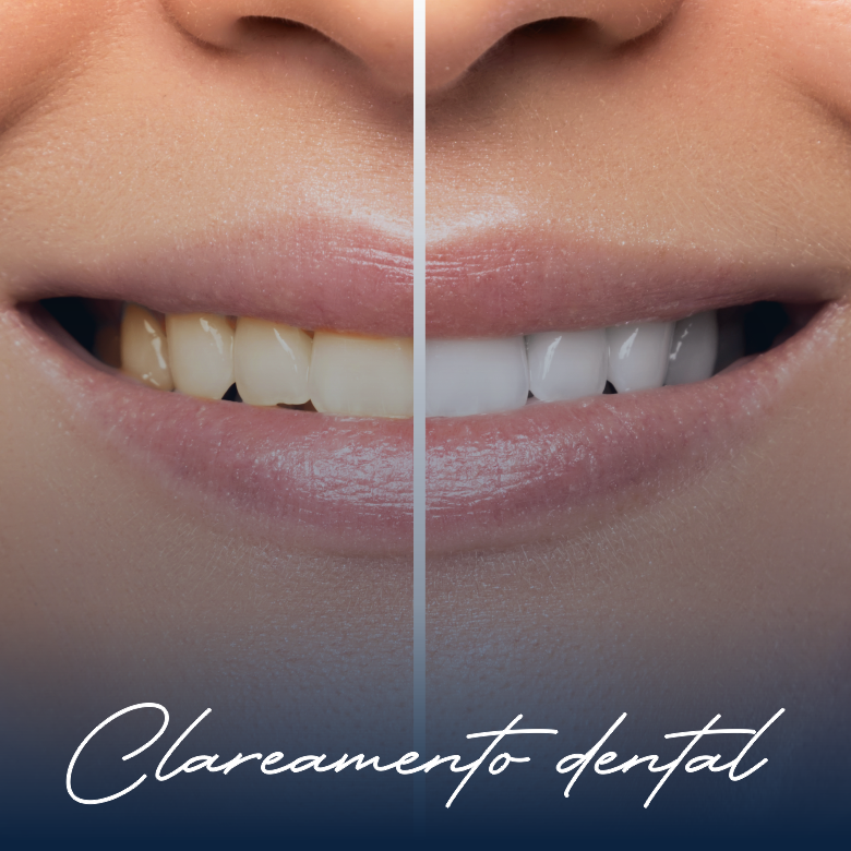 clareamento dental